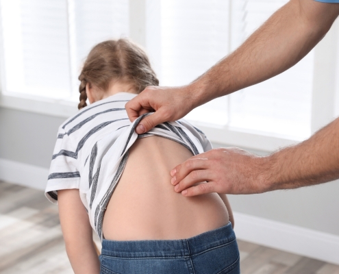 Skolyoz dereceleri, Cobb açısı