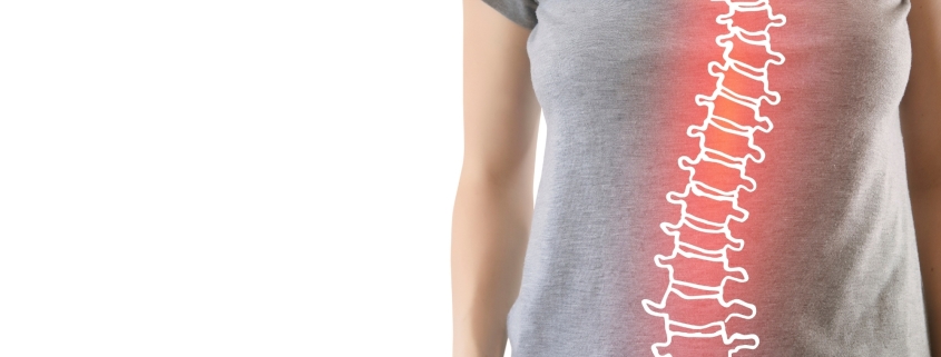 Skolyoz nedir,Omurga eğriliği nedir, skolyoz neden olur, skolyoz belirtileri, skolyoz çeşitleri