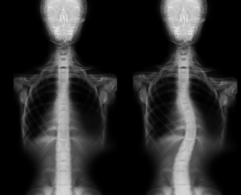 omurga eğriliği,omurga eğriliği dereceleri, omurga eğriliği düzelir mi, skolyoz belirtileri, kifoz nedir, omurga eğriliği egzersizleri