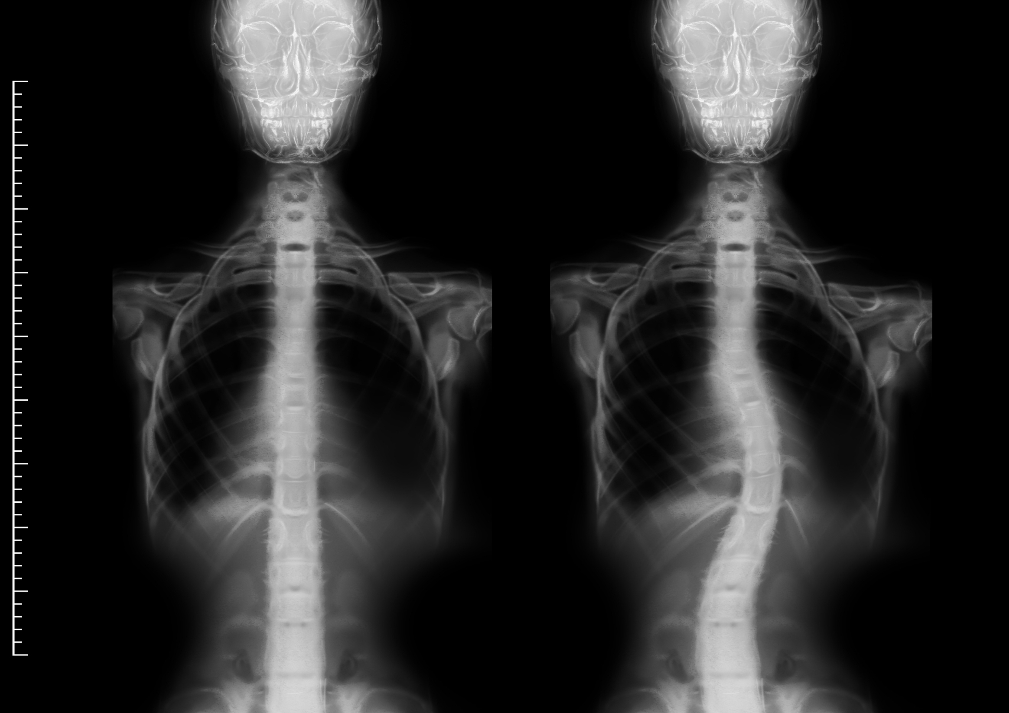 omurga eğriliği,omurga eğriliği dereceleri, omurga eğriliği düzelir mi, skolyoz belirtileri, kifoz nedir, omurga eğriliği egzersizleri