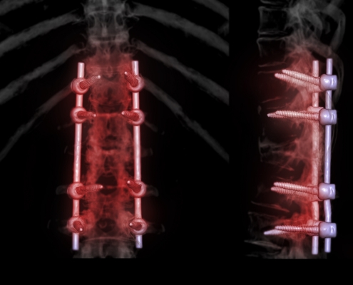 omurga kanal darlığı