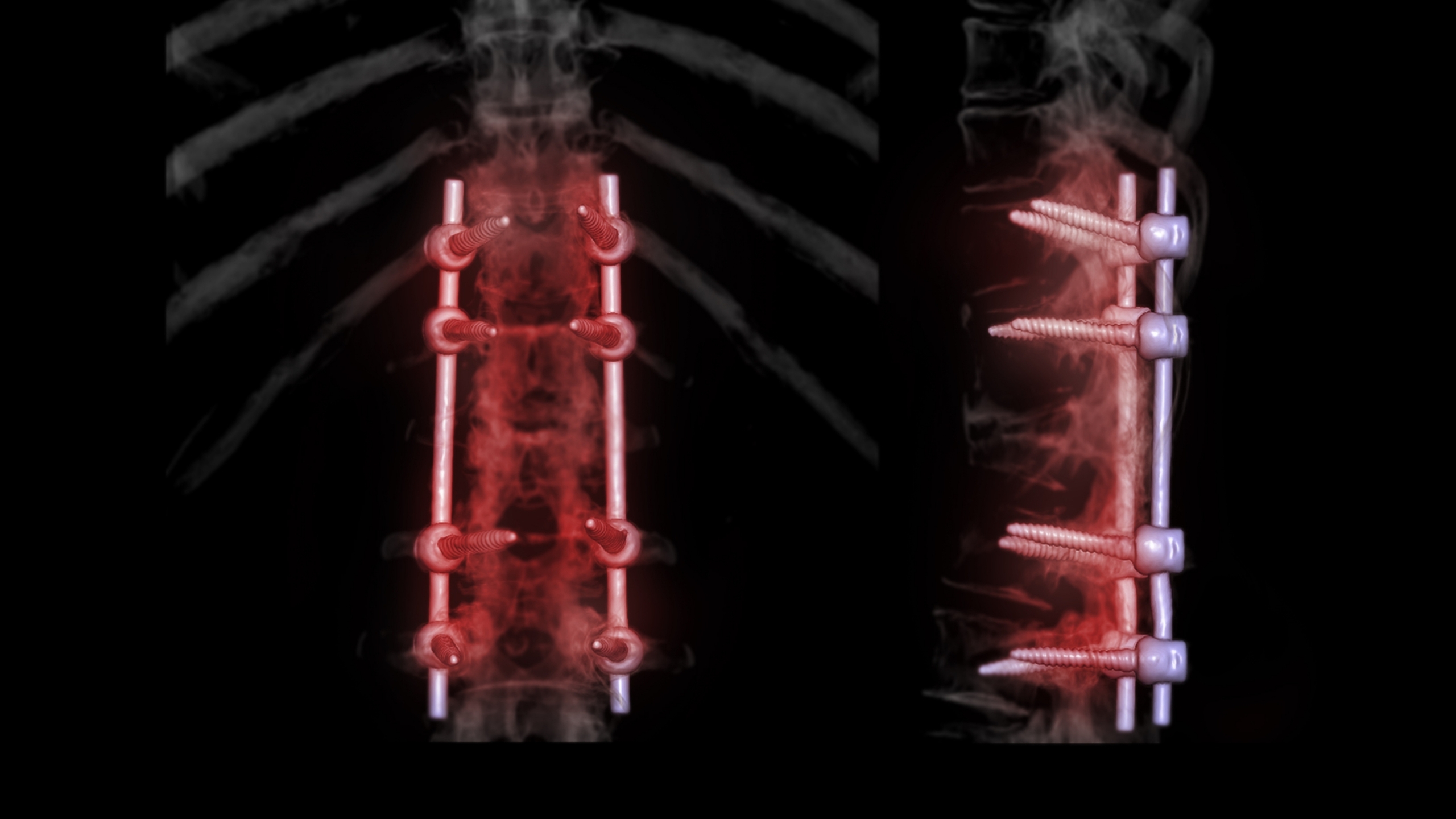 omurga kanal darlığı