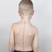 What happens if scoliosis progresses?